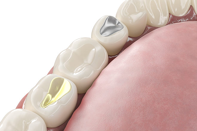 つめ物・かぶせ物が取れた