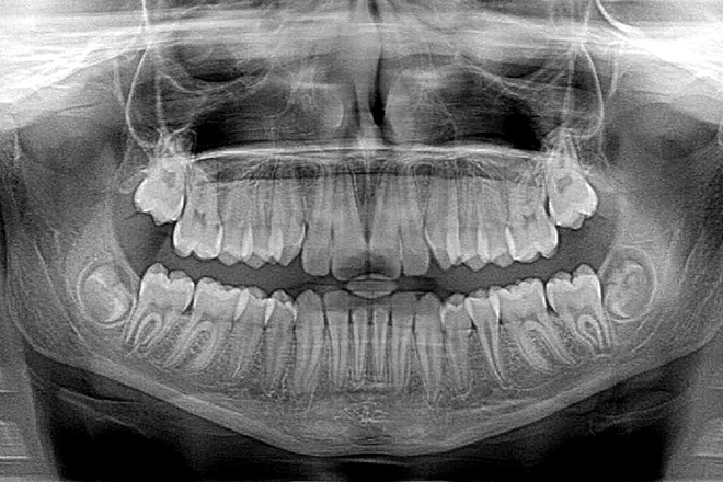 親知らずを抜きたい