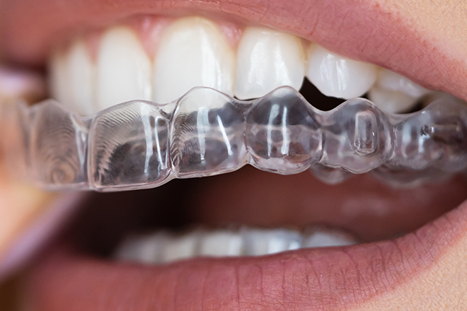 歯並びを治したい