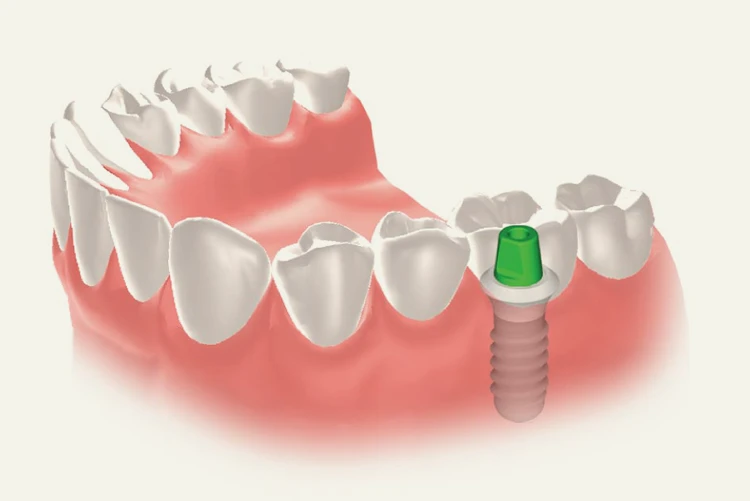 インプラント治療